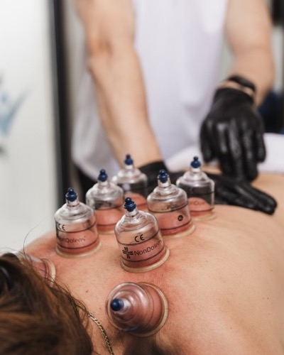 Glazen cups op de rug tijdens een cuppingbehandeling